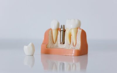 Guía para pacientes: Preparación y cuidados antes y después de un tratamiento de implantes dentales